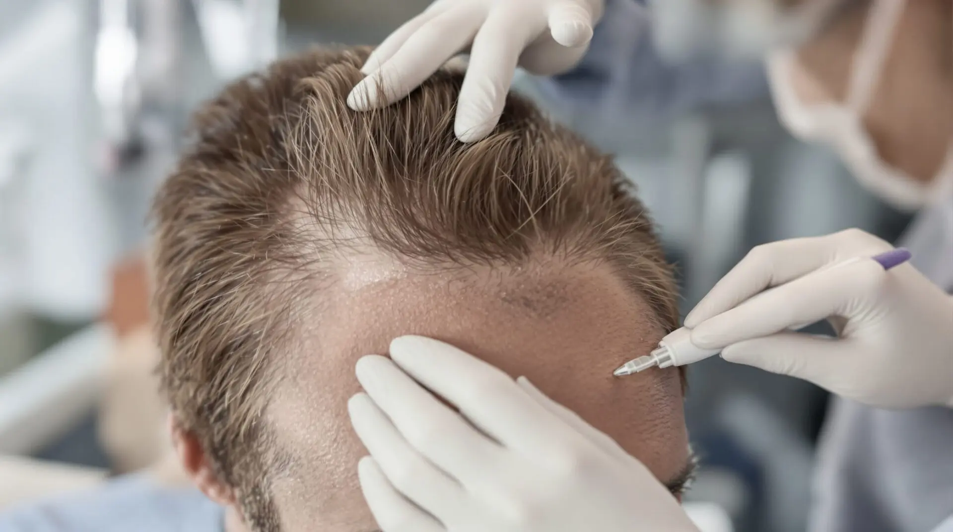 Comprendre la greffe de cheveux : techniques, indications et précautions pour un résultat naturel et durable